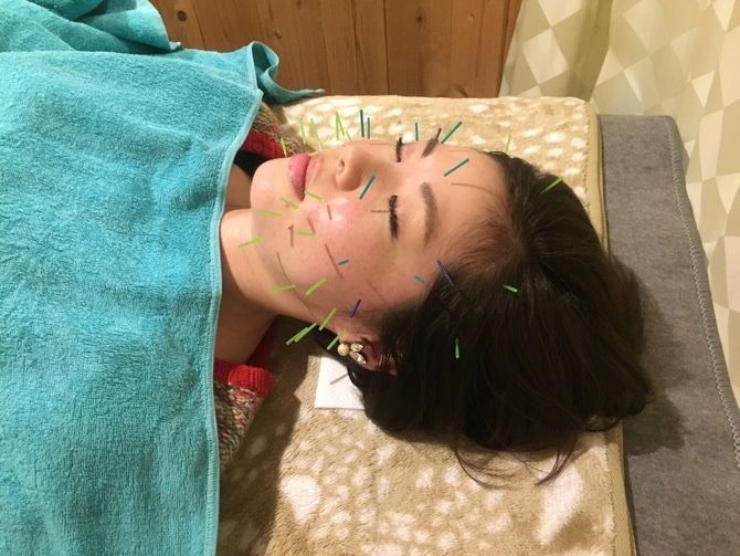 美容とリラックスに抜群！美顔鍼ですっきり！