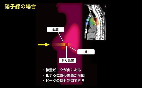メディポリス国際陽子線治療センター